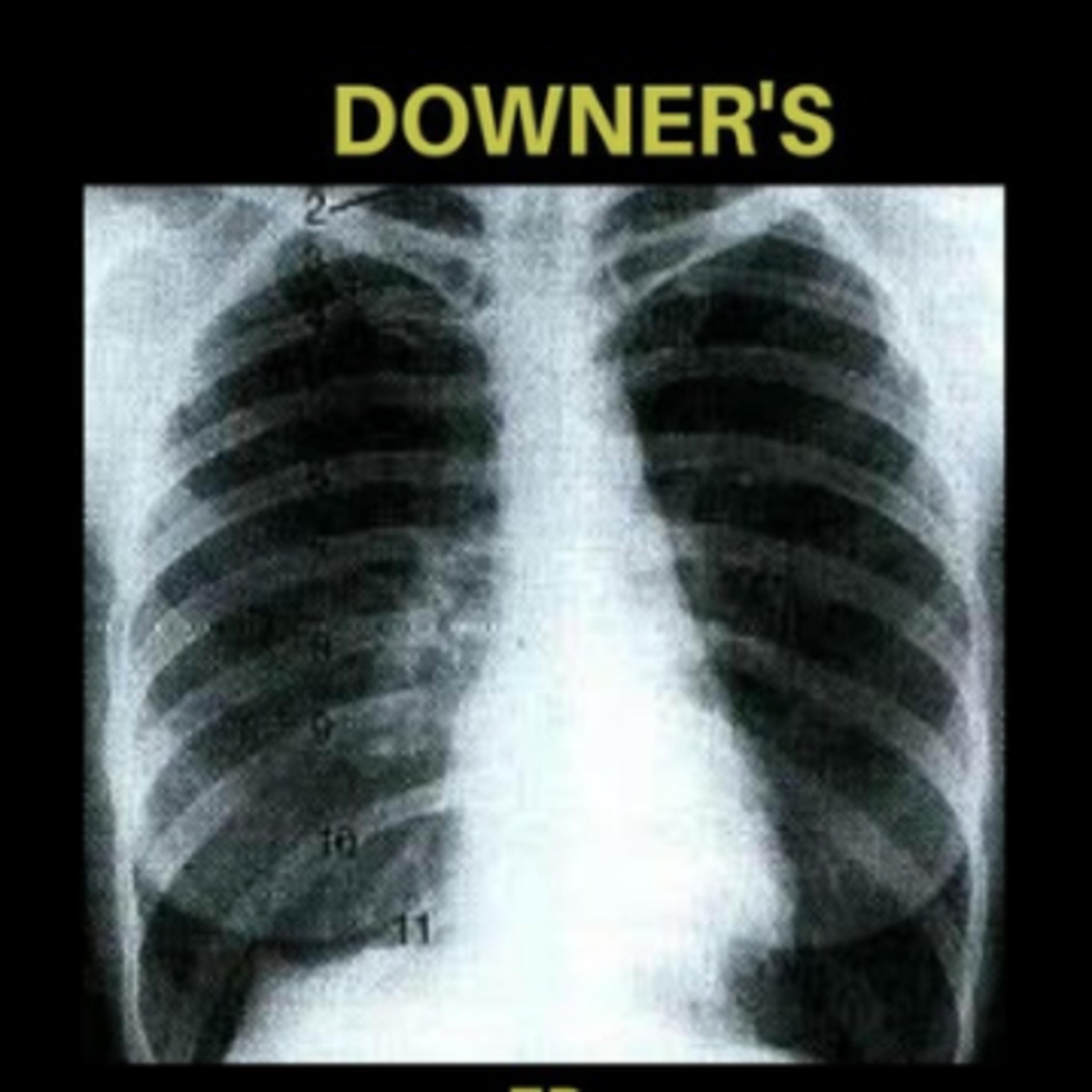 Downer's